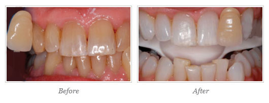 Kor Whitening Before After 08