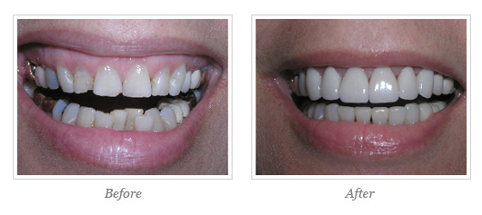 Porcelain Veneers Before After 10