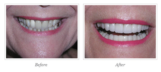 Porcelain Veneers Before After 11