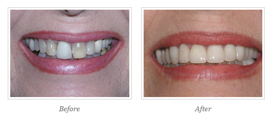 Porcelain Veneers Before After 13