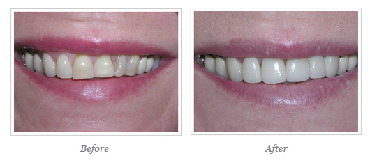 Porcelain Veneers Before After 14
