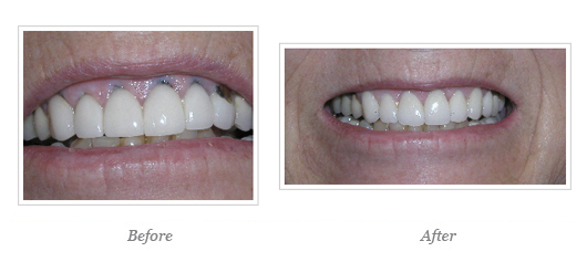 Porcelain Veneers Before After 16