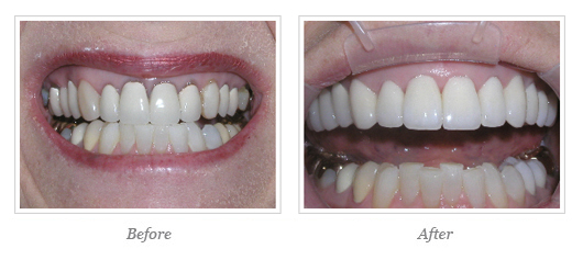 Porcelain Veneers Before After 17