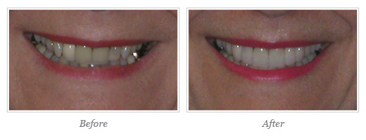 Porcelain Veneers Before After 02
