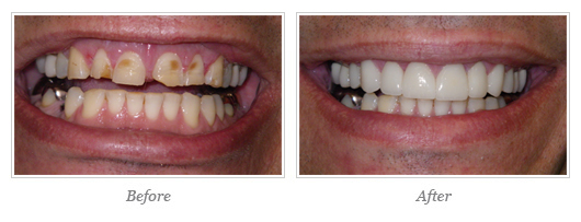 Porcelain Veneers Before After 03