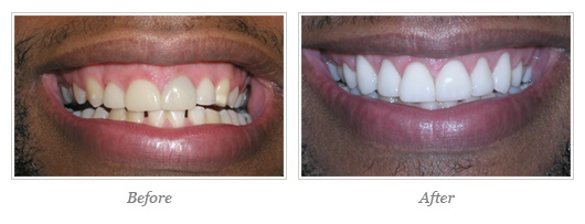 Porcelain Veneers Before After 04