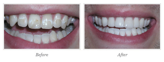 Porcelain Veneers Before After 06