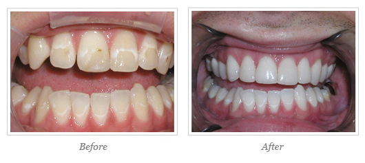 Porcelain Veneers Before After 07