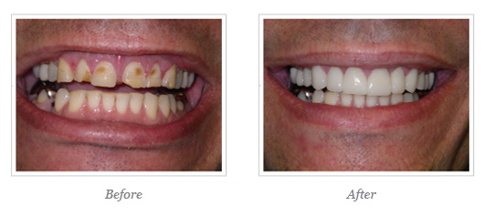 Porcelain Veneers Before After 08