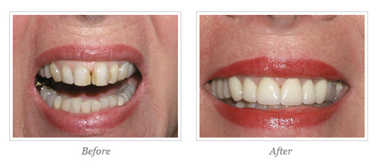 Porcelain Veneers Before After 09