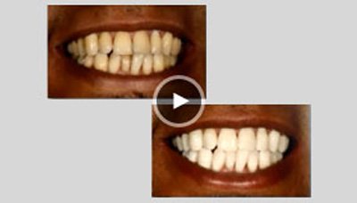 Teeth Whiteing
