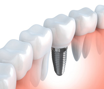 Price is not a barrier to treatment in Orange County with affordable dental implants