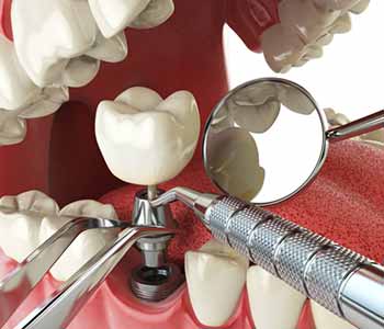 Full mouth dental implants from a dentist near me in Costa Mesa