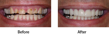Dental Crown Before After Case-01