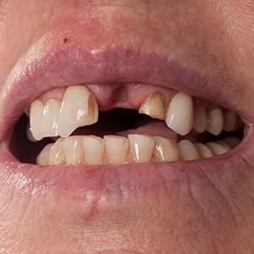 Dental Accidents
