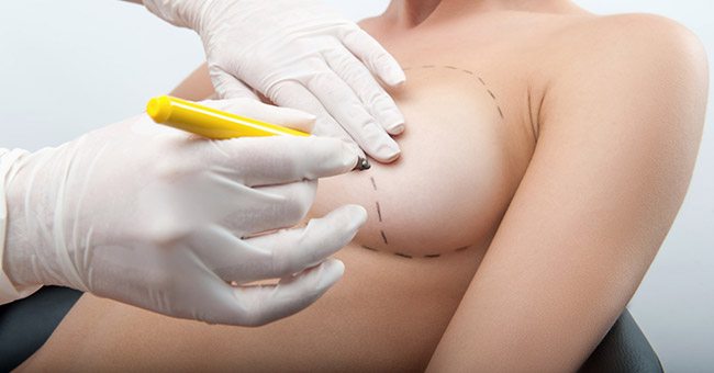 Breast Augmentation