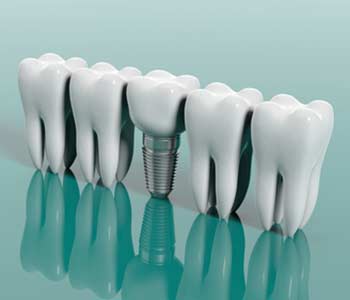 How to Mentally Prepare for Dental Implant Surgery in Moonee Ponds area