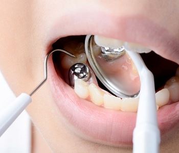 amalgam filling removal from dentist