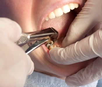 Safe Amalgam Removal from expert dentist in Melbourne