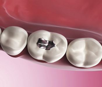 Amalgam Removal Melbourne - Amalgam Filling