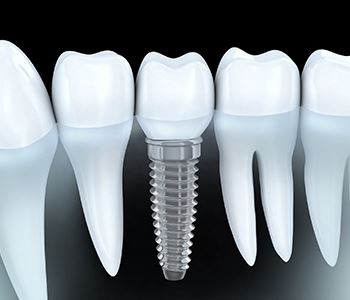 dental implants from moonee ponds