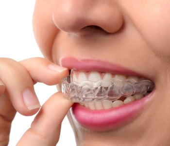Invisalign Braces from dentist in Sunbury