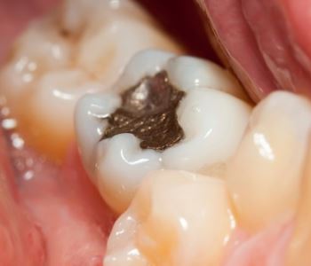 Safe Amalgam Filling Removal from dentist in Melbourne