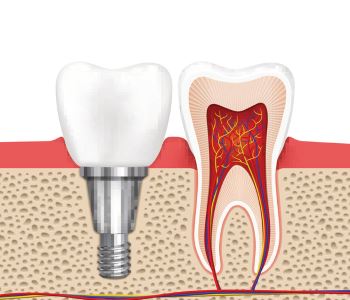 Sunbury Implant from Dentistry 3429 area