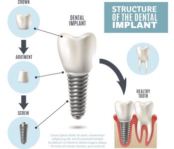 Tooth Implant Procedure from dentist in Sunbury