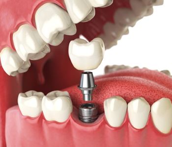 Tooth Replacement Options from dentist in Sunbury