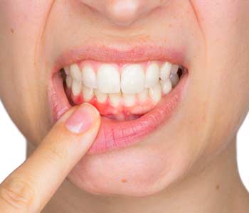 young woman showing with her finger inflamed lower gingiva with pain expression.