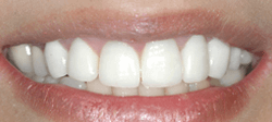 Crowns and Bridges - After