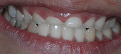 Crowns and Bridges - Before