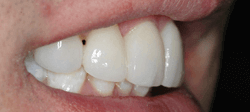 Teeth Whitening - After