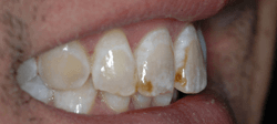Teeth Whitening - Before