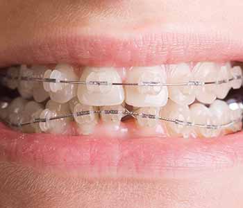 Mississauga ON family dentists are proud to provide patients with braces for straighter teeth
