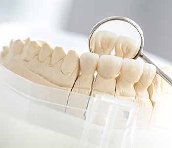 Dr. Ratra offers the advanced CEREC technology in Mississauga ON for one-day dental crowns.