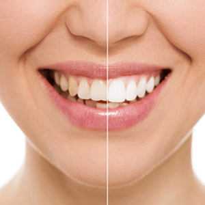 Deep Dental Cleanings Mississauga