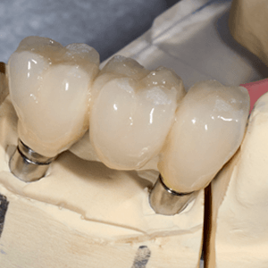 Dental Crowns Mississauga