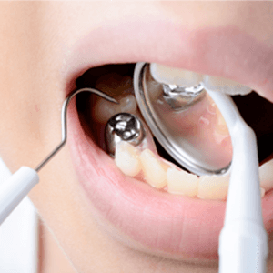 Dental Fillings Mississauga