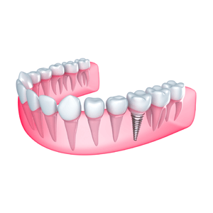 Dental Restoration Mississauga