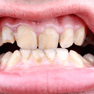 Gum Disease Mississauga