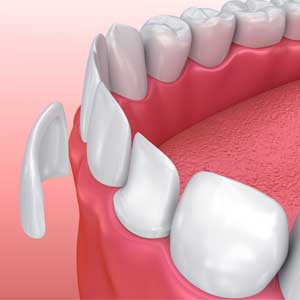 Porcelain Veneers